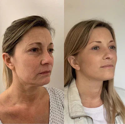 Capsula Hidratante De Colágeno Para El Cuidado Facial 32 Cap