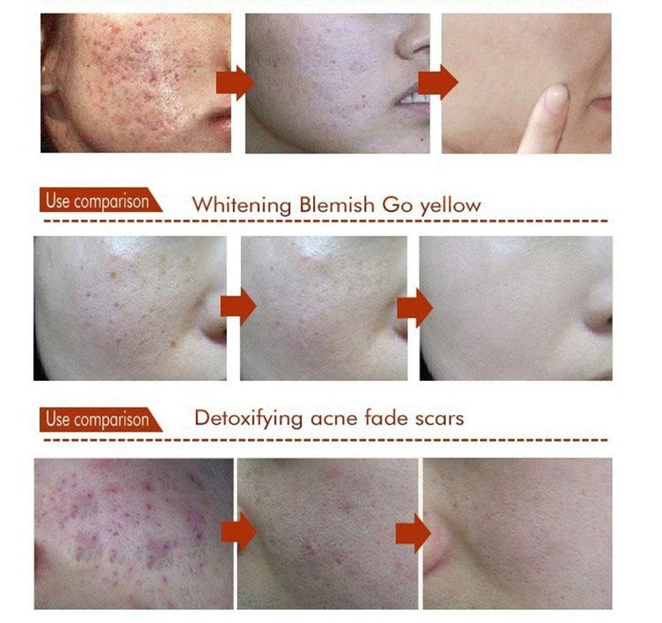 BIOAQUA - Gel natural Eliminadora de acné y cicatrices
