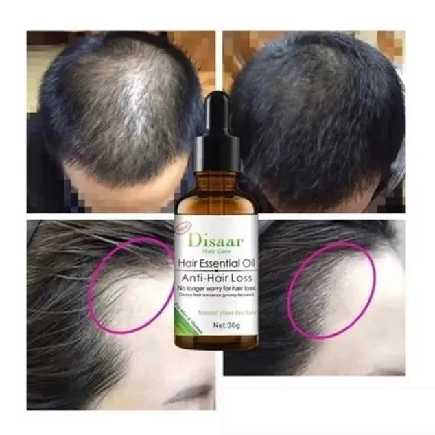 SUPER OFERTA ( PAGA 1 Y LLEVA 2) - Anticaída Cabello Aceite , Alopecia Calvicie